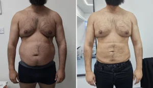 liposuction before and after