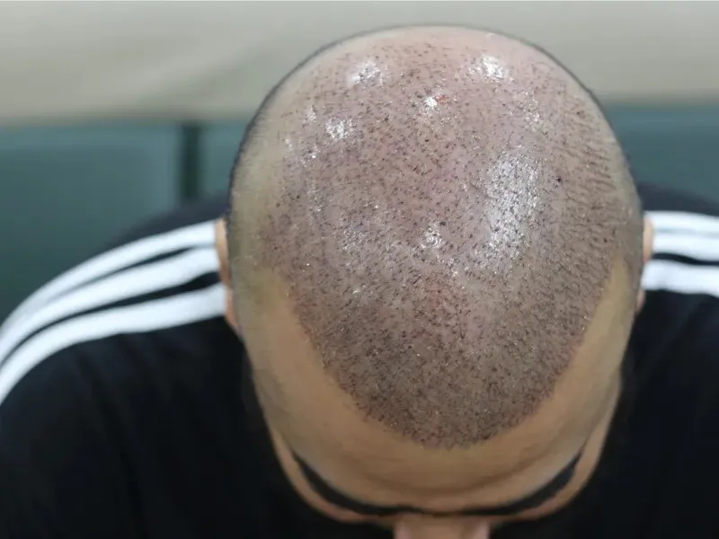 DHI hair transplant in Lahore Karachi Peshawar Islamabad Faisalabad