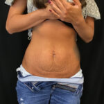 Flat Belly Clinic, Referensi Informasi Klinik untuk Prosedur Body Contouring dan Estetika 1before-tummy-tuck-1